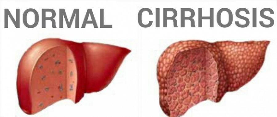 Normal versus Cirrhotic Liver