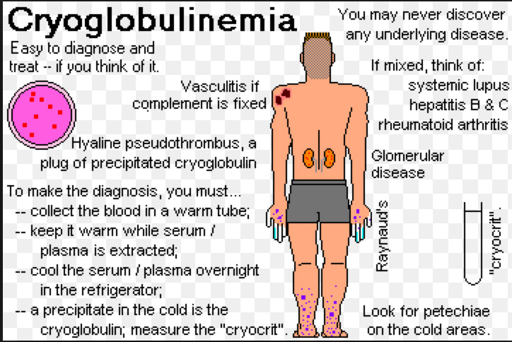 cryoglubulinemia.jpg